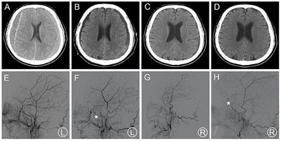 Middle Meningeal Artery Embolization for the Treatment of Bilateral Chronic Subdural Hematoma